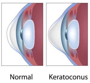 cross section of eye with keratoconus