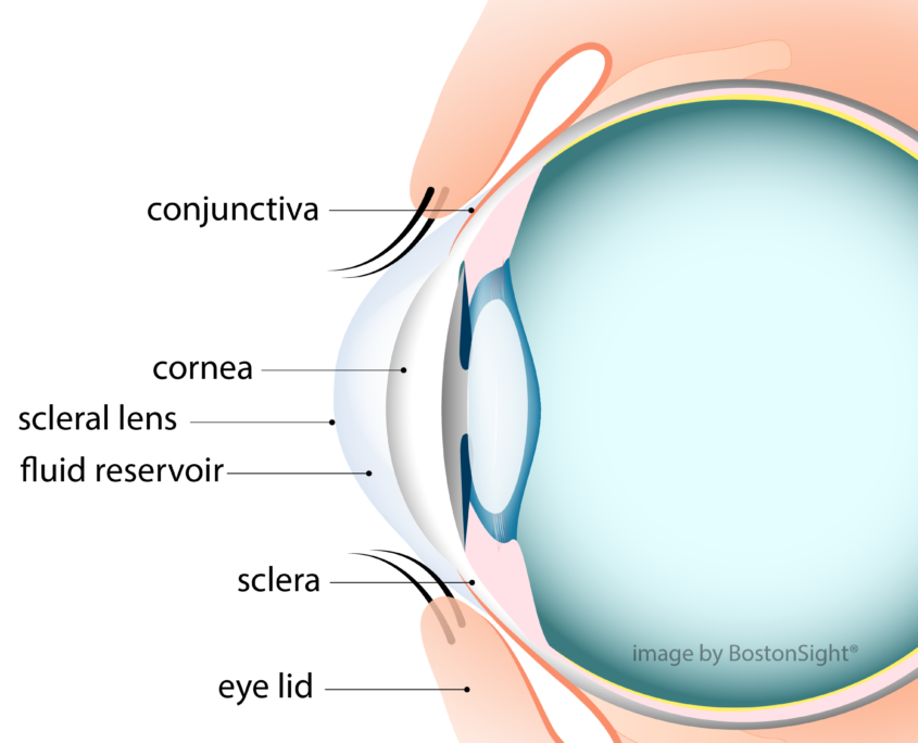 Scleral Contacts Scleral Lens Basics for Patients BostonSight SCLERAL