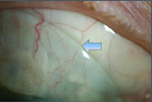 Ensuring Positive (Scleral) Impressions