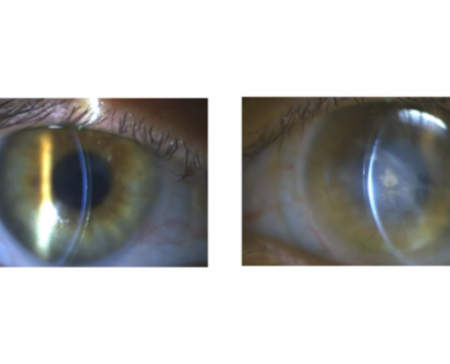 Practitioner Interview: Restoring 20/20 After a Rare Complication